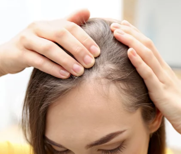 Female Hair Loss Treatment Singapore