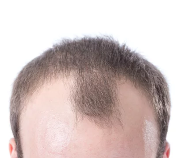 Receding Hairline Treatment Singapore