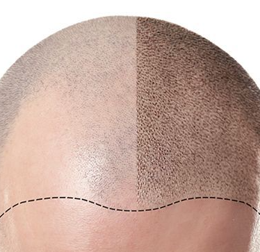 Scalp Micropigmentation vs Hair Regrowth