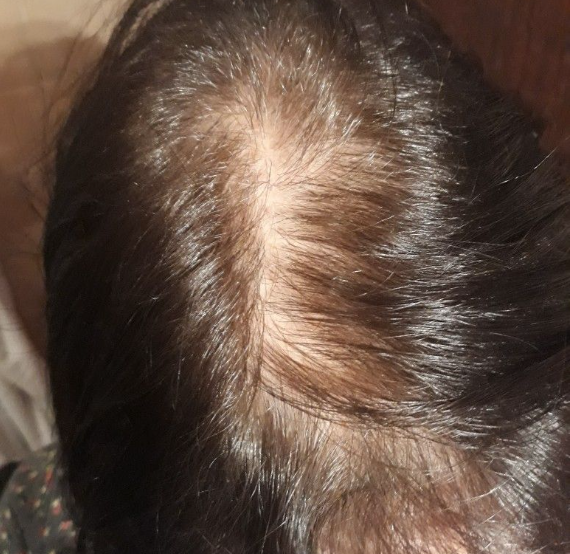 female pattern hair loss Singapore · telogen effluvium women