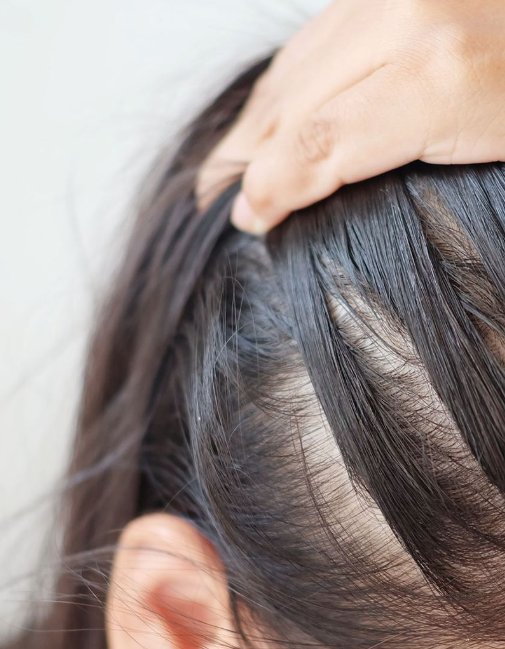 hair loss singapore