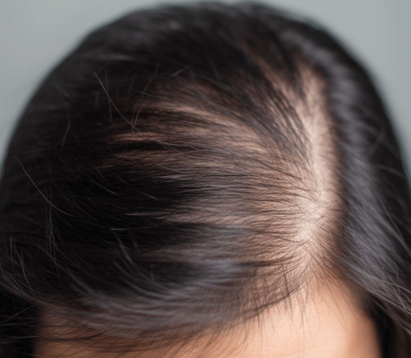 hormonal hair loss women Singapore