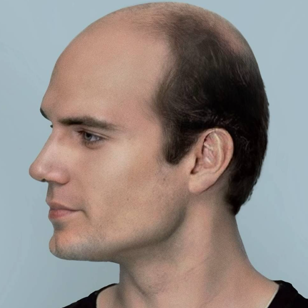 male pattern baldness singapore