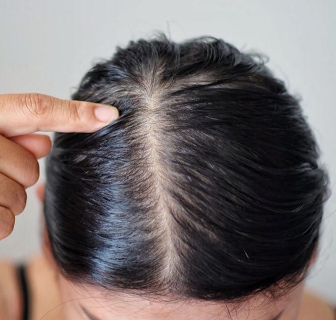 oily scalp thinning hair