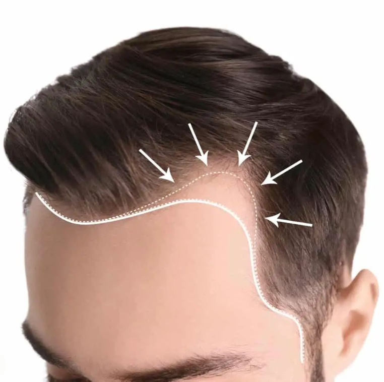 receding hairline Singapore